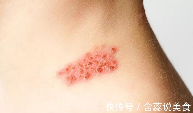 小痣|癌症来临时,皮肤会出现4个变化,希望你可以及时知晓