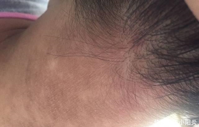 医院|9岁小女孩脖颈发黑洗不掉,经医院检查后,医生的话却让家长笑了