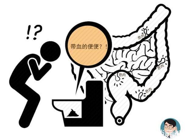 大便|排便莫名出现4种征兆,或暗示大肠癌易上身,趁早检查,别忽视
