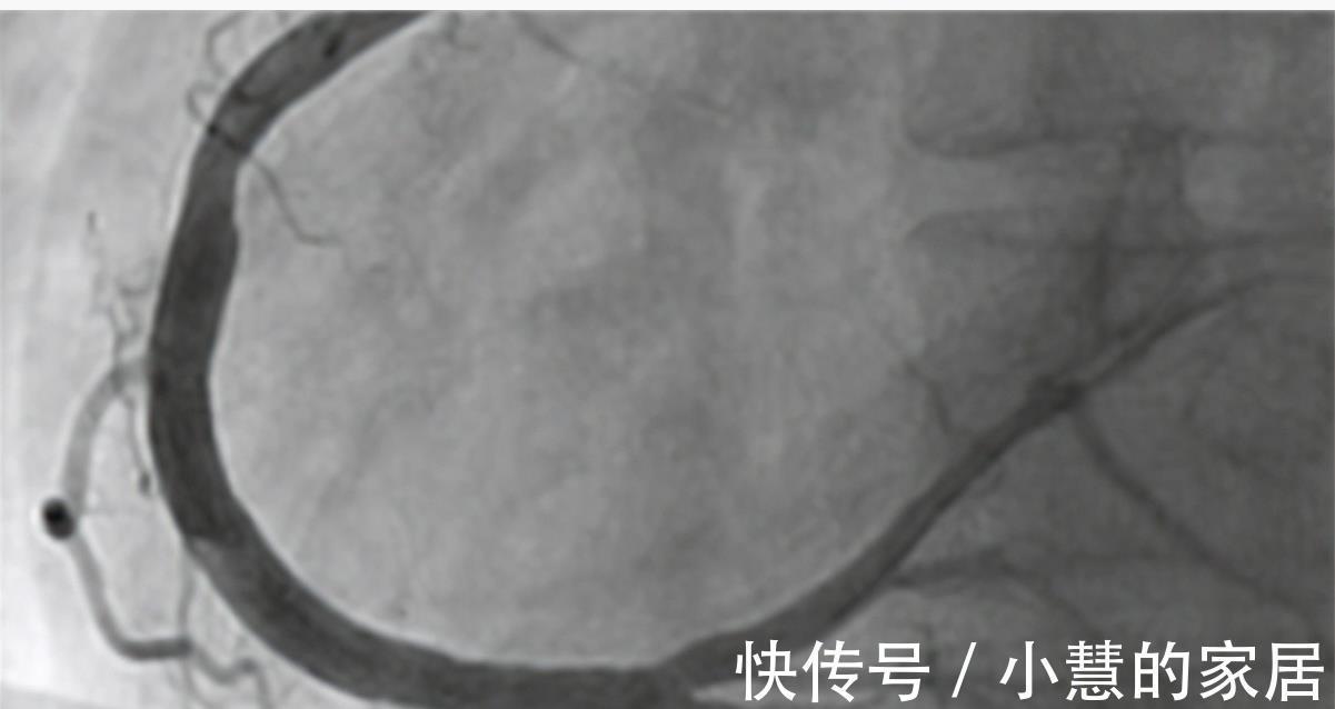 冠状动脉造影|8年冠心病没吃药,复查冠脉造影竟然“消失”了!冠心病能自愈?