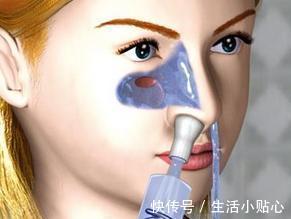 鼻腔|鼻腔冲洗对鼻炎患者来说有什么作用呢？主要是这4个方面