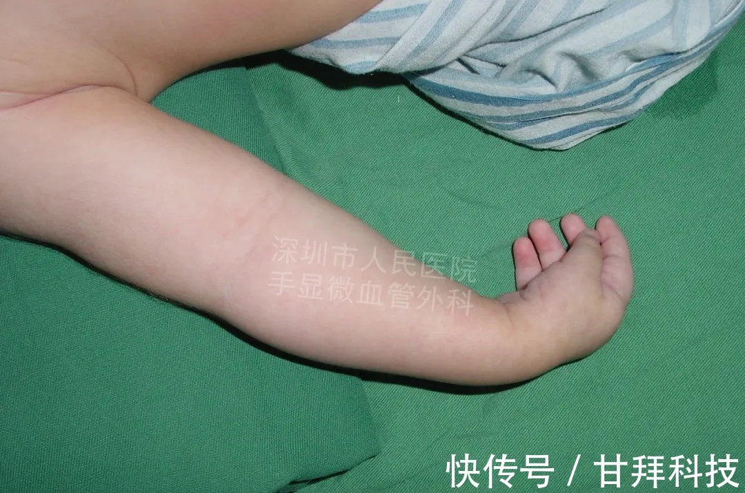 男孩|得了这病,12岁男孩手指比香蕉还粗!7种常见的手部畸形,家长们要注意