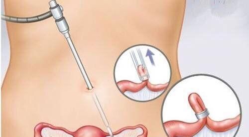 剖腹产|二胎剖腹时要不要结扎?过来人:关键看夫妻两人感情好不好