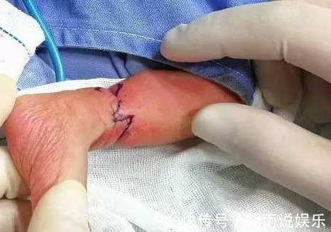小晓|胎儿在妈妈肚子里腿被“绑绳”,孩子刚出生,医生可能要截肢