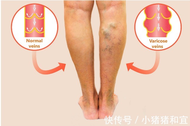 患病率|血脂升高，腿脚先知！腿脚出现4种“怪象”，提示你该降血脂了