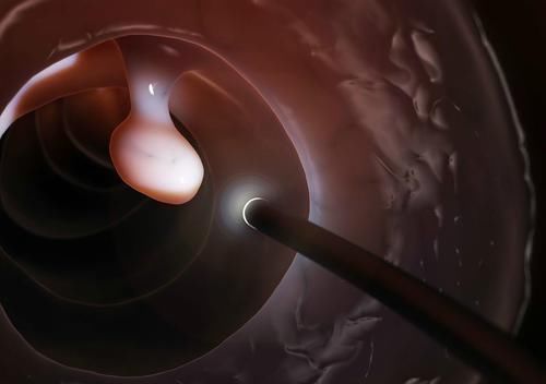 征兆|癌症会提前告诉你的四个征兆,医生提醒,三个部位最好每年体检