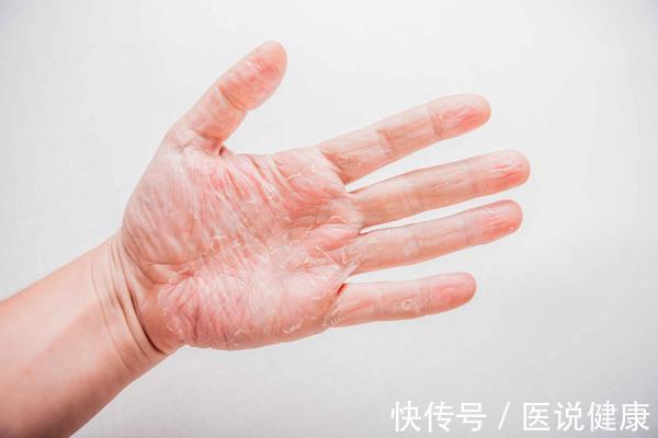 维生素|手脚经常出现脱皮现象，或与这4个因素有关，了解后，及时调理