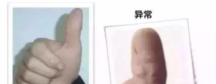 菊花粥|肺癌给他的信号,却被他忽视了,最终被确诊为肺癌晚期