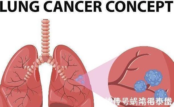 冬病夏治|34岁的妇女患有皮疹,身体检查发现患有肺癌,因为忽视了一些变化