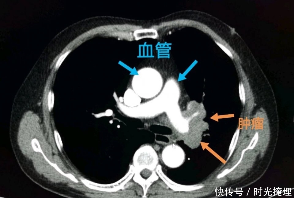  化疗|化疗会造成癌症扩散吗？