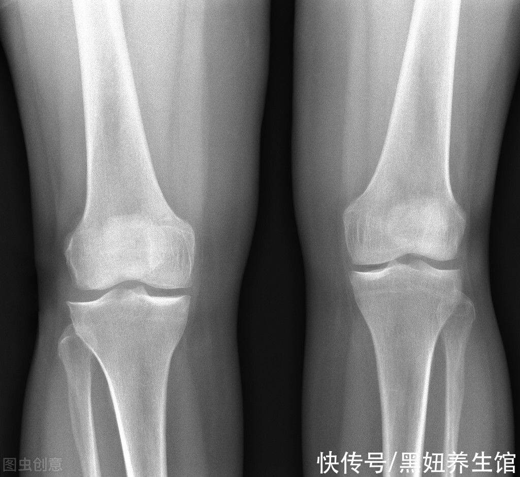 跑步|提醒:这个行为比跑步更伤膝盖,现在知道还不晚