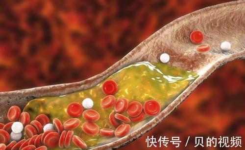 血脂|血脂偏高的人,饮食莫大意,牢记少碰4种调味料