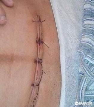 剖腹产|宝妈剖腹产十六天了,包的刀口能拆开了吗?拆后怎么护理?