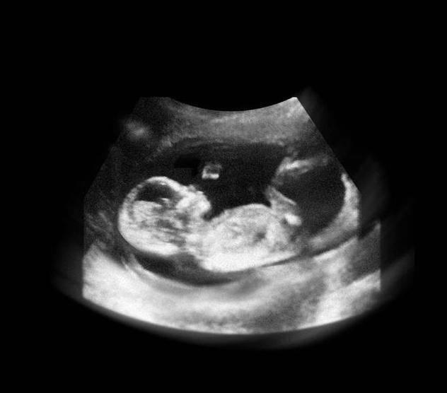 性别|胎儿从卵泡到性别形成,17张图片清晰诠释,男宝女宝看得很清楚