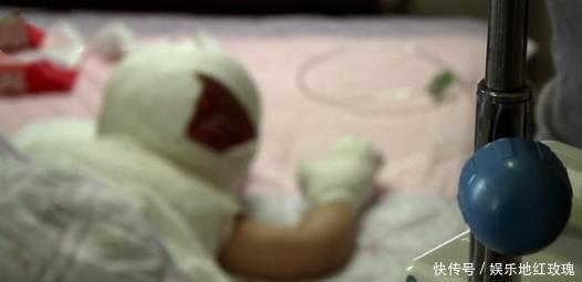 烧伤科|5人不同程度烧伤，2岁幼儿瞬间变火团！罪魁祸首竟是一只大鹅