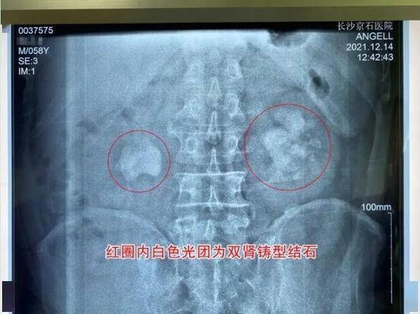 男子|男子每天腰痛到全身冒汗，入院就医才知道……