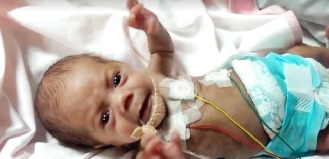 重症监护室|14年过去,原本身体巴掌大“世界最小宝宝”,如今颜值高到认不出