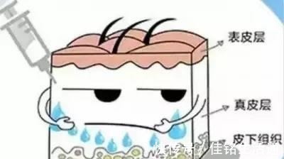 水光 医美干货分享水光针适合你吗!