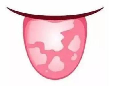 地图舌|一张治小孩“地图舌”的方子！地图舌到底咋回事，此文讲清楚