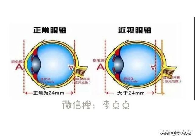 李点点|4.9亿人在围观,这个吃糖吃成1500度近视的女孩
