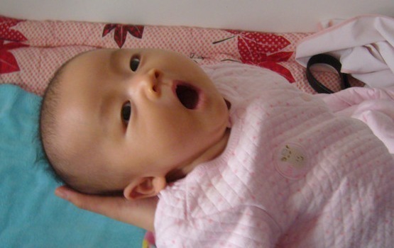 皱褶|两个月大的婴儿身体发臭,医生查出结果,婆婆怒斥儿媳无知