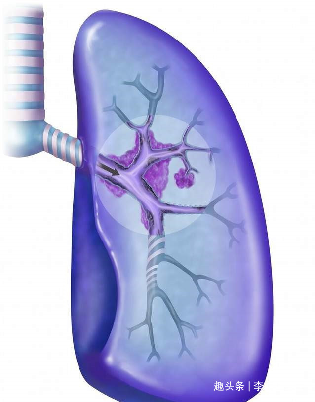 蛋白质|女子双脚水肿,诊断肾病综合征,直到出现咳嗽医生才发现是肺癌
