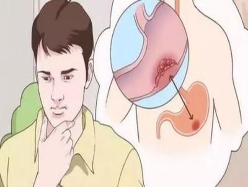 大便|痔疮和肠癌傻傻分不清，中年男子查出肠癌，大便早已“提醒”