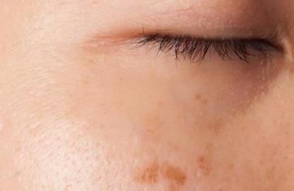 肝脏疾病|肝癌怎么越来越多,医生:有一种水果比喝酒更伤肝,不妨看一看