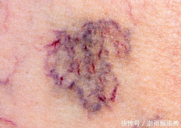 下肢|体内有栓,手脚先知?手脚若有这4种异常,或是血管在“求救”