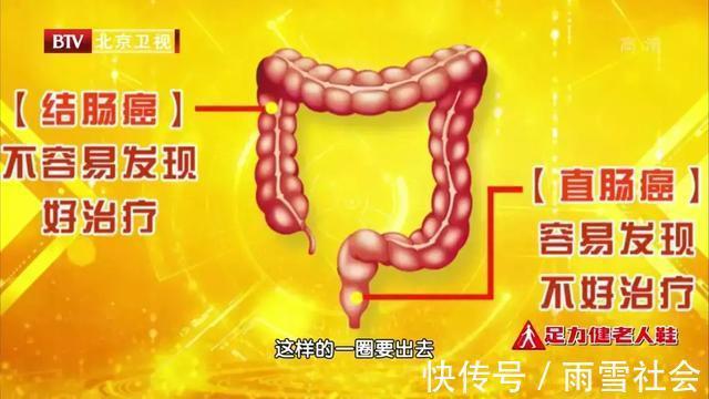 林主任|全新抗癌疗法!直肠癌中晚期,不开刀,肿瘤细胞竟然完全消失了