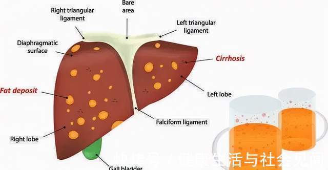 恶性肿瘤|癌症发病率为什么呈年轻化趋势?于加军:这5个行为,少碰才好