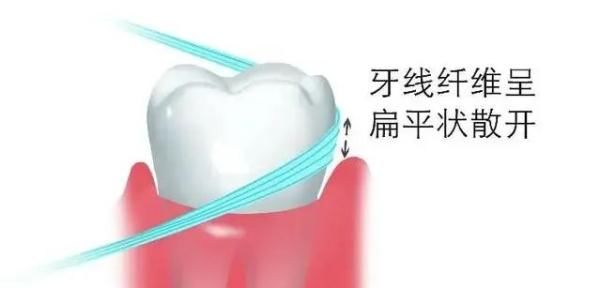 牙线|全国爱牙日丨牙线会撑大牙缝吗？