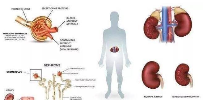 肾病|糖尿病16年,血糖稳定在6.1,赶走肾病,无并发症,方法有2点