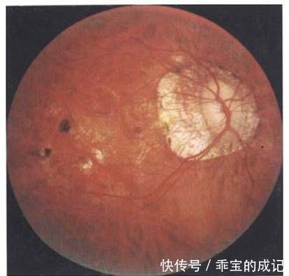 玻璃膜|近视超过600+？我建议你看看自己的眼底，绝对惊恐！