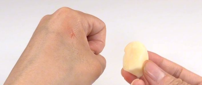 被蚊子咬了太痒难受教你一招,不用买药,快速止痒