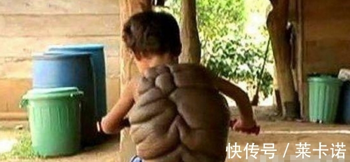 治疗|奇闻：男孩背上长龟壳，父亲要扔掉，治疗后成这个模样