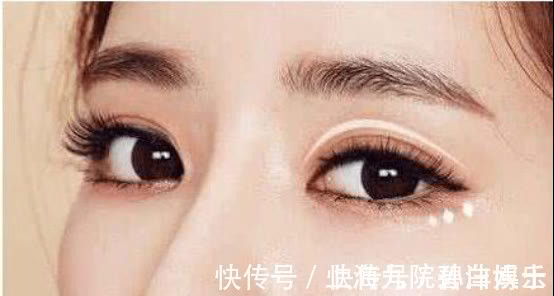 重睑线 眼修复孙沣博士:双眼皮术后是否会产生疤痕和增生?