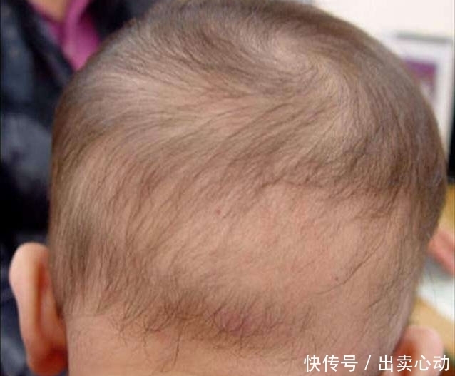 幼儿园|2岁孩子要补习5科,压力太大出现“鬼剃头”,医生见后异常惊讶