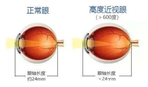 病理性|近视的“生长”史!