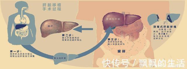 化疗|22岁妹子罹患肝癌，医生建议肝移植，妹子思考良久：不做