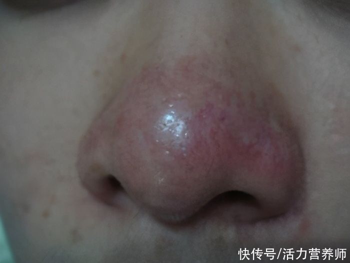 从鼻子上挤出来的白色物质，到底是什么？告诉你答案和处理办法