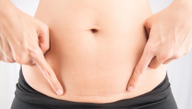 剖腹产|剖腹产后多久可以同房这个错误认知需警惕,以免留下健康隐患