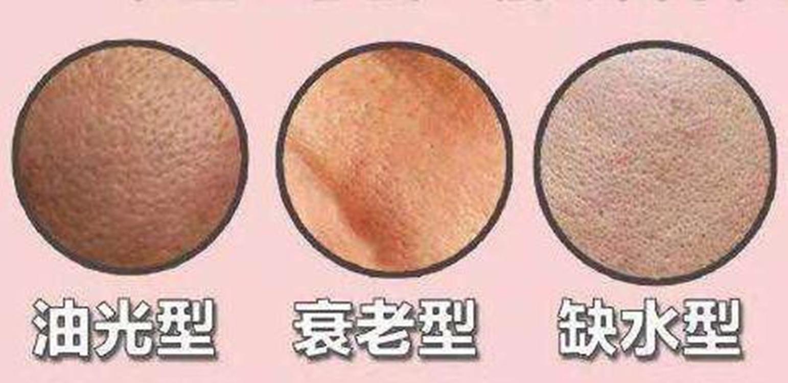 回事|毛孔粗大别不当回事,这几个问题需要注意,避免形成“马蜂窝”