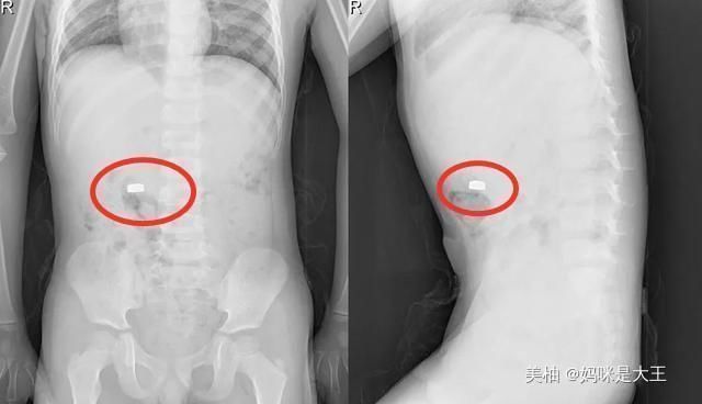 “妈妈,告诉你个秘密”,宝妈听后一脸惊吓,立刻带儿子去了医院