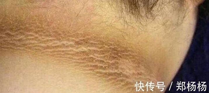 假性黑棘皮病|6岁小女孩脖颈发黑洗不掉,去医院做检查,医生的话让妈妈笑了