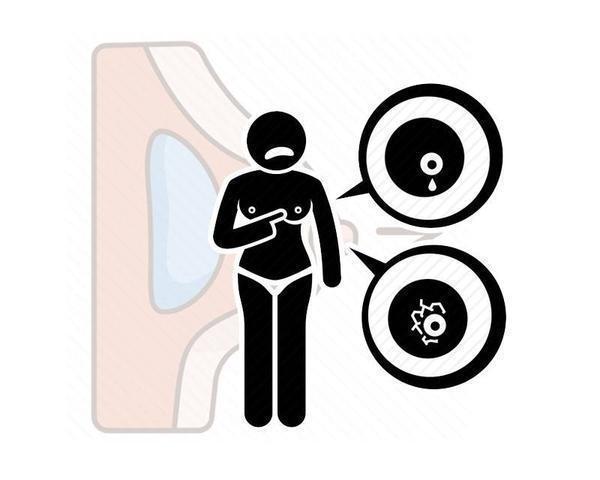 排查|乳腺癌早期排查,记住这3个“苗头”,一旦发现及时掐灭