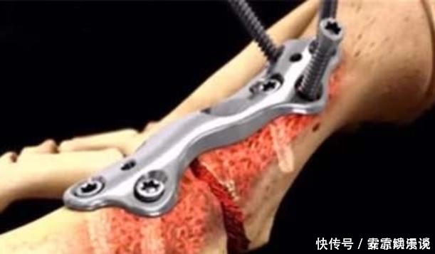 过程|病人断掉的“筋”是怎么接起来的看完动画演示过程,总算明白了