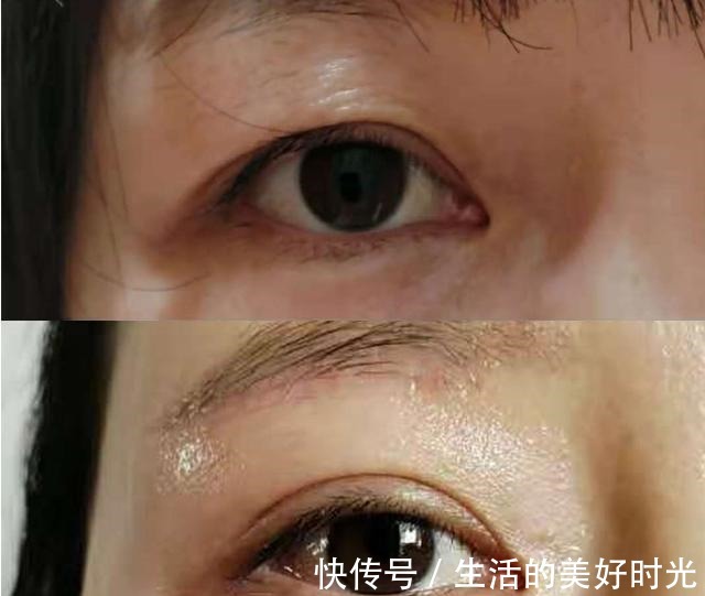 眼皮 提眉手术,求美者关心的问题!