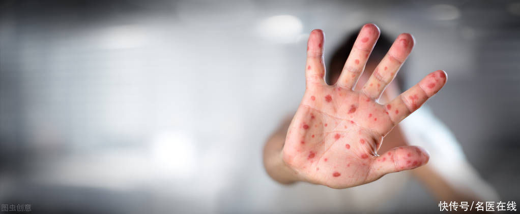 阴囊|乳房、肛门、阴囊统统躲不过!被湿疹入侵的隐私要怎么治?