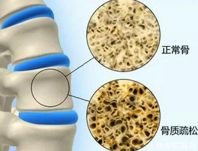 院士|骨質疏松不能吃雞蛋?82歲院士:2種食物更應少吃，建議撤下餐桌